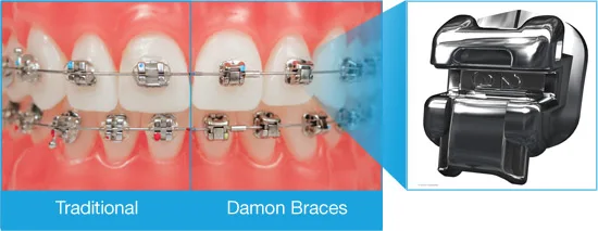 Self-Ligating Braces